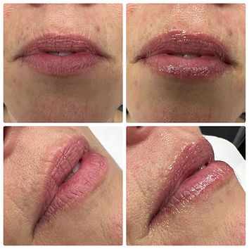 Lippen vor und nach der Fotona-Liplase®-Behandlung bei der Queen's Beauty World AG