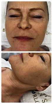Gesicht vor der Fotona-4D-Facelift®-Behandlung bei der Queen's Beauty World AG