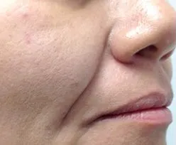 Gesicht vor der Fotona-4D®-Facelift-Behandlung bei der Queen's Beauty World AG