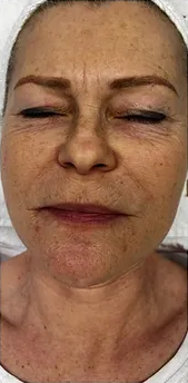 Gesicht vor der Fotona-4D-Facelift®-Behandlung bei der Queen's Beauty World AG