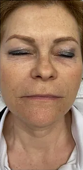 Gesicht nach der Fotona-4D-Facelift®-Behandlung bei der Queen's Beauty World AG